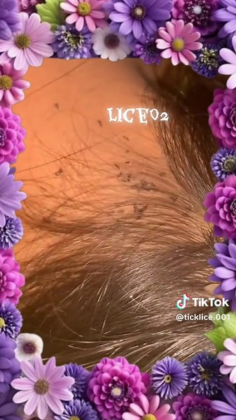 Lice and Tick Removal Guide