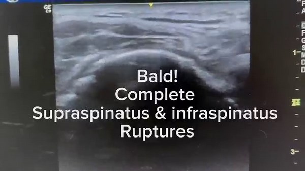 #musculoskeletalus #bicepstendon #rotatorinterval #shoulderimaging | Luke Millward