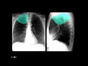 CXR Anatomy