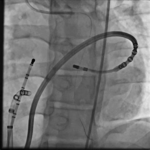 A 16-year-old boy with high-burden ventricular arrhythmia (VA) was referred to an electrophysiology laboratory. Endocardial pace mapping pointed to near right ventricular apex with 92% surface QRS correlation, but ablation resulted in right bundle branch block and maintenance of VA. Epicardial mapping revealed VA origin in the midsection of the anterior interventricular groove. https://bit.ly/3I4ShA0 #JACCCaseReports | JACC Journals