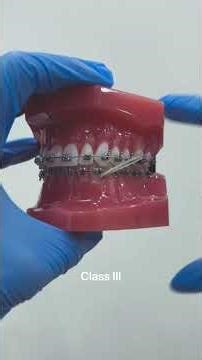 Different types of elastics