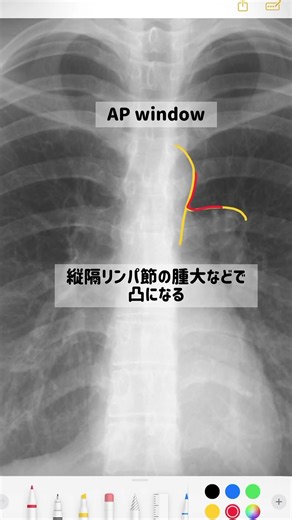 胸部単純写真シリーズ＃3 AP window #radiology #anatomy#放射線科#胸部単純写真#レントゲン#読影