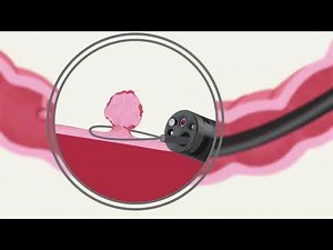 What to expect during and after your colonoscopy