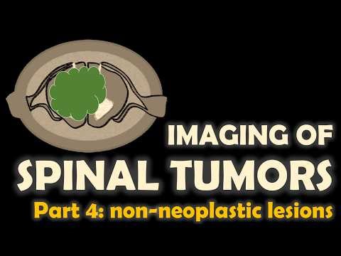 Imaging of spinal tumors, part 4: non-neoplastic lesions