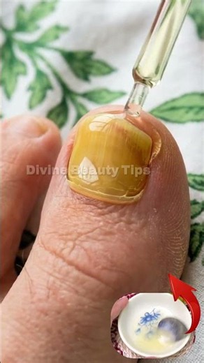 🚨 Your damaged nails need this simple DIY care! 🌿💅 Try this simple home remedy to help your nails
