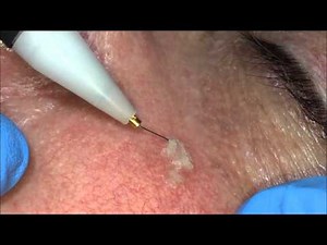 Skin Treatments on a wonderful lady: Removal of benign imperfections using advanced electrolysis