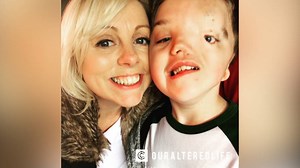 Instagram apologizes for removing photo of autistic boy with facial birth defect