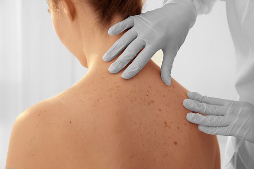 Cancer de la peau : cause, symptôme, traitement, à quel âge ?
