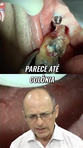 Extraction of an infected tooth