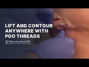 Using PDO Threads for a Neck Lift