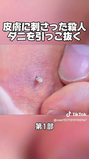 皮膚に刺さった殺人ダニの除去方法