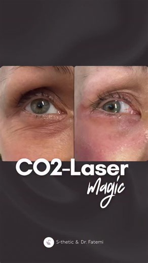 S-thetic Gruppe on Instagram: "⚡️CO2-Laser magic (treatments by @drfatemi ) Sofort sichtbare Straffung mit dem CO2-Laser. Die Haut wird während der Behandlung sichtbar gestrafft - das Ergebnis ist sofort zu erkennen. Das gezeigte Vorher-Nachher-Bild zeigt einen Patienten, der an den Unterlidern behandelt wurde. Im Video selbst sind verschiedene Patient:innen während einer CO2- Laserbehandlung zu sehen. Hast du Fragen dazu? Schreib sie gerne in die Kommentare. 🦢💕 Immediate tightening with the C