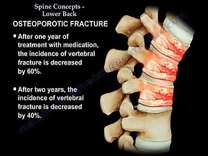 Low Back Pain - Causes, Diagnosis and Treatment • Video • MEDtube.net
