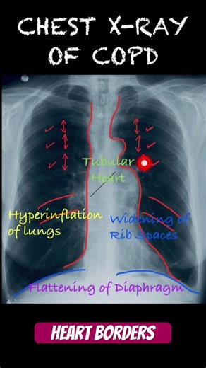 Chest X-ray of COPD/Emphysema in 20 seconds #neetpg #radiology #mbbs #xray #emphysema #neet