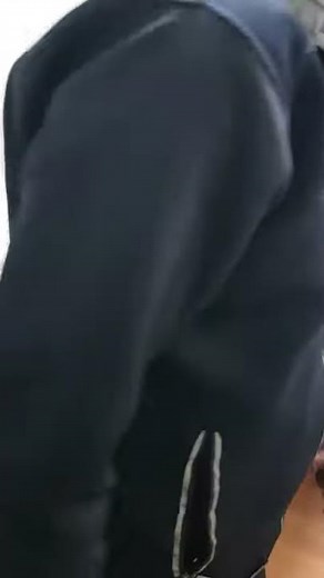 Spastic Hemiplegic Gait on Left Side