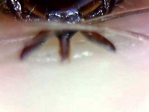 tick biting human leg extreme close up lots of detail