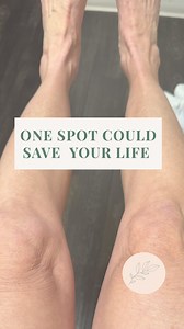 When was your last full skin check? My family member found a small skin cancer spot — and thankfully, it was caught early. Radiation instead of surgery. No spread. Just 10 minutes that made all the difference. Dermatologists recommend a full-body skin exam once a year — or twice a year if you’re high-risk (fair skin, history of burns, or family history). It’s painless. It’s fast. And it could save your life. If you read this far, promise me you’ll check. Comment “I booked it” or tag someone who 