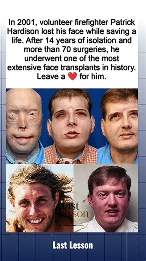 He Lost His Face in a Fire — 14 Years Later, Everything Changed ❤️