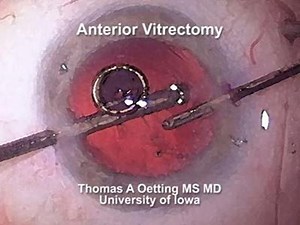 7K views · 114 reactions | Anterior Vitrectomy Tips | Piece of ophthalmology | Facebook