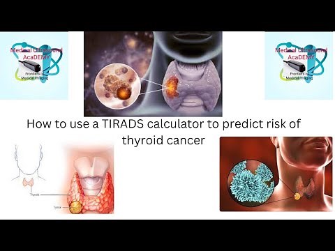 How to use the TIRADS calculator to predict the risk of thyroid nodule cancer or malignancy.