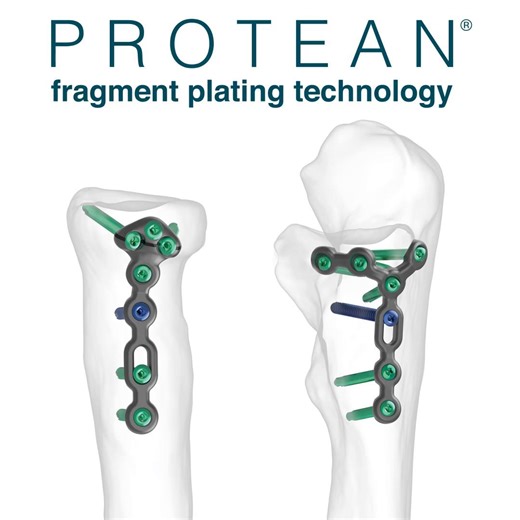 Skeletal Dynamics | PROTEAN® Fragment Plating Technology - True in-situ contouring after screw insertion. https://skeletaldynamics.com/products/protean/ | Instagram