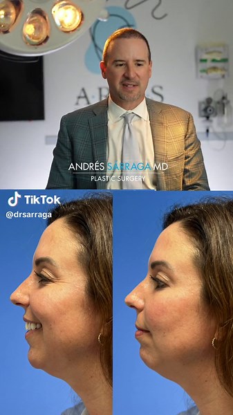 Simple Lift   Chin Implant ✨🪄 #plasticsurgery