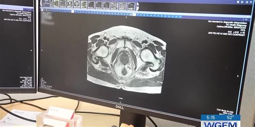 Patient #1 for non-surgical treatment for colorectal cancer