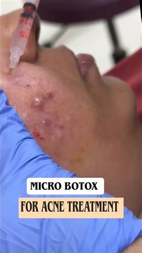 Micro Botox For Acne treatment Skin smile clinic Bhopal #microbotox #skinsmileclinic