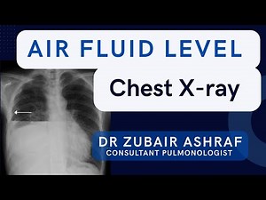 Chest Xray with Air-Fluid level #radiology #cxr
