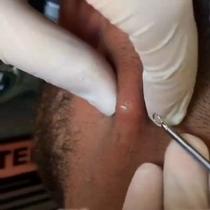 Pimples Show on Instagram‎: "Follow us for more videos 👍 Watch pimple compilation Tag your friends ⬇️ . . . #acne #antiaging #acnetreatment #blackheadremoval #blackhead #blackheads #blackheadextraction #facialathome #cyst #clearskin #dermaplaning #drpimplepopper #dermaplane #glowingskin #oilyskin #pimple #pimplepopper #pimpleproblems #pimplepopping #pimplepoppers #pores #skincare #naturalskin #sivilcesıkma #zits #skinhealth #skincaretips #черныеточки #выдавливаниепрыщей #جوش"‎