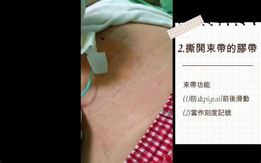 How to remove a pigtail catheter 如何移除豬尾巴引流管？步驟、護理備物(PTCD, PTGBD, liv