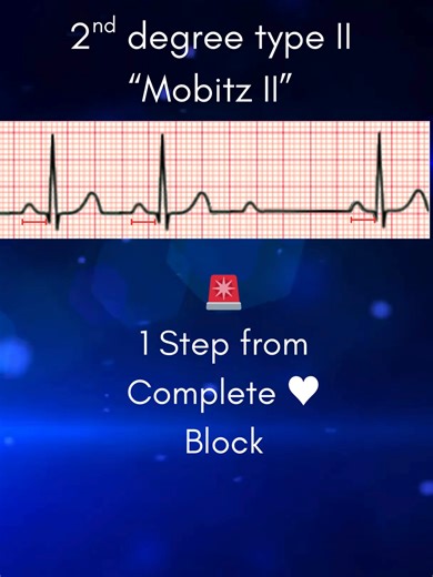 Heart Block Song | Second Degree Type II Verse Full lyric video available now! Learn AV blocks the easy way 🎵 This song reviews: • First-degree AV block • Second-degree Type I (Wenckebach) (Mobitz I) • Second-degree Type II (Mobitz II) • Third-degree (complete) heart block • Assessment & Treatment basics Perfect for ECG interpretation, ACLS review, and NCLEX prep. #nursingstudent #ecg #acls #heartblock Heart_block.png by Npatchett, via Wikimedia Commons. Licensed under CC BY-SA 4.0. https://com