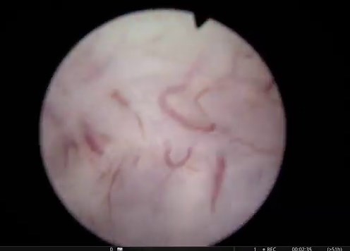 The HoLEP plane that we always love to see. Case 22