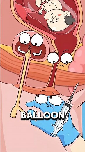 Why Doctors Insert a Catheter During Labor 😳🩺..!!#e2dhealth #animation #2dshow #health #fypシ