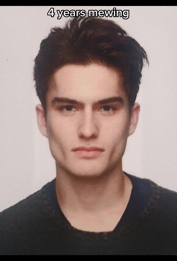 4 Years Mewing Transformation - Jawline Progress & Results