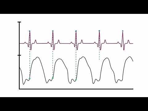 How the LV Waveform is Derived and LVEDP Calculated