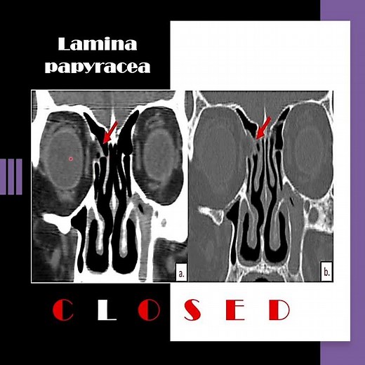 Nose ardiology series (8): The lamina papyracea (4)