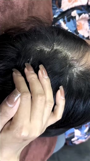 Remove Big Dandruff Flakes Scratching Back