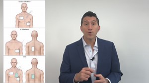🚨 New Handtevy Minute 🚨 Double Sequential Defbrillation (DSED) ⚡⚡ 1 in 5 cardiac arrests present in a shockable rhythm. Your protocol calls for standard defibrillation with antero-lateral pad placement. But what happens when your patient stays in ventricular fibrillation? Have you ever brought a patient to the ED in refractory VF only to hear the ED physician ask, "How long have you been working the patient?" And when they hear your answer they call the code soon thereafter? Now there is a ran