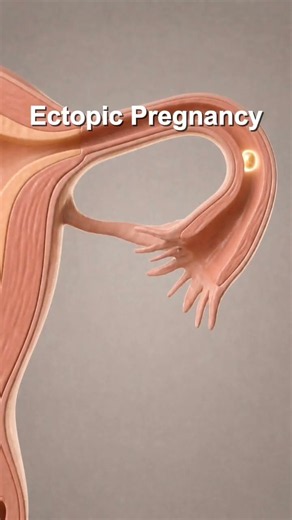 What Is an Ectopic Pregnancy?