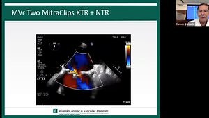 Complications of Mitral Valve Repair with MitraClip: Single Leaflet Device Attachment, Clip Embolization, Residual Shunt and LVOT Obstruction