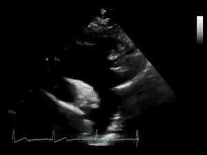 Echocardiography SSN (Aortic Arch)
