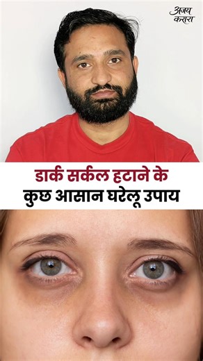 Dark Circle Ke Liye Home Remedy? Under Eye Dark Circles Ka Natural Ilaj | Ajay Karara