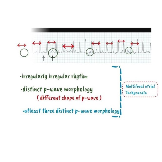 Multifocal atrial Tachycardia | Tachyarrythmia| ECG cardiology