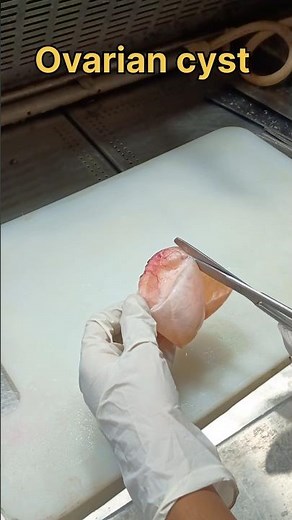 Ovarian cyst specimen 😳😟| #histopathology #ovariancyst #cystitis #cyst #histomuseum #ovariancancer