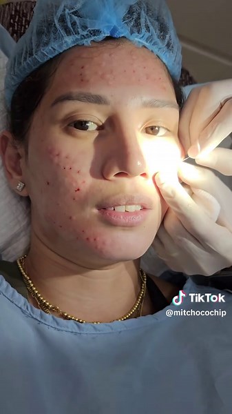 Plasma Injections for Facial Rejuvenation: Price Revealed