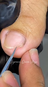 Hidden Surprise, painful yet satisfying #ingrowntoenail | Ingrown Queen Vlogs