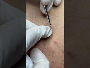 Nặn mụn ở lưng | Popping back acne