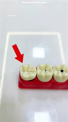 99% of People Ignore This Tiny Cavity Until It's Too Late! 😱🦷