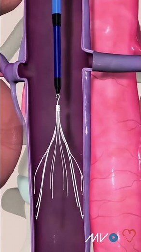 Why retrieve an IVC filter?